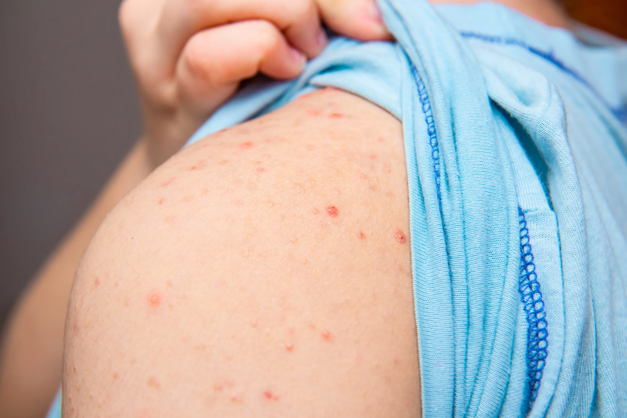 Bed bug bites on the shoulder of an adult.