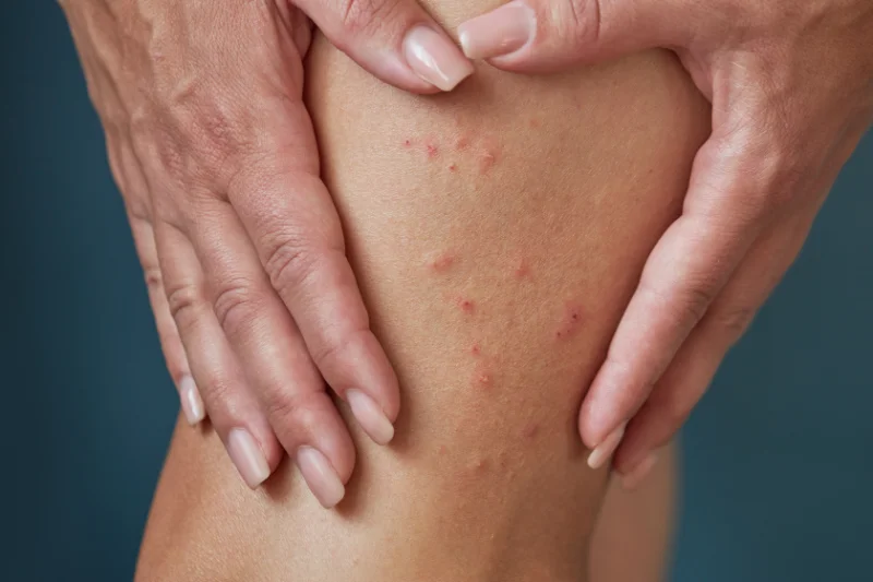 A close up person holding their leg covered in flea bites